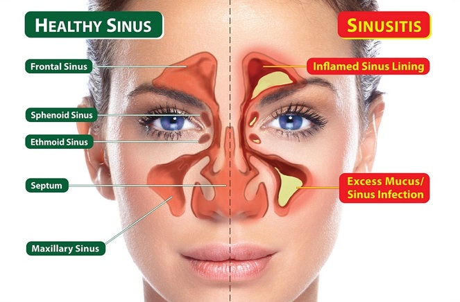Sinus
